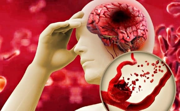 nhồi máu não, dấu hiệu nhồi máu não, đột quỵ 