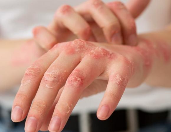 mưa ngập, ghẻ lở, sức khỏe