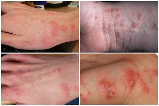 mưa ngập, ghẻ lở, sức khỏe