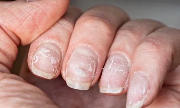 ung thư, dấu hiệu ung thư, biểu hiện ung thư trên móng tay
