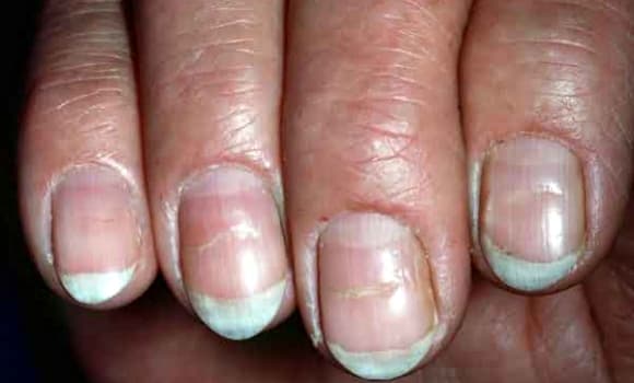 ung thư, dấu hiệu ung thư, biểu hiện ung thư trên móng tay