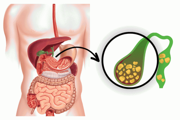 sỏi mật 1 sức khỏe, sỏi mật, sỏi mật ở phụ nữ,