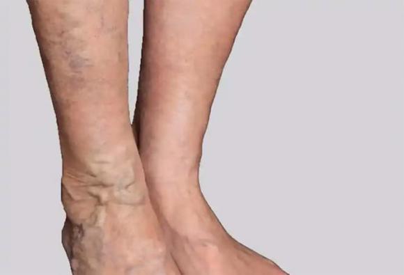 Đại học Harvard, cục máu đông