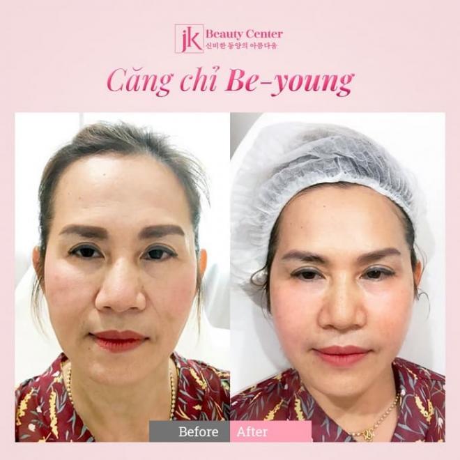 Phòng khám JK Việt Nam, Trẻ hóa da, xóa nhăn, căng chỉ Be-Young