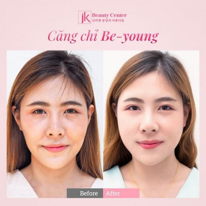 Phòng khám JK Việt Nam, Trẻ hóa da, xóa nhăn, căng chỉ Be-Young