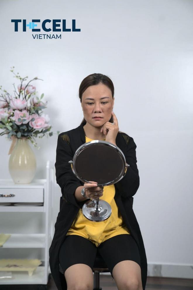 Công nghệ Max Cell, xóa nám và tàn nhang, Phòng khám Thẩm mỹ The Cell Việt Nam