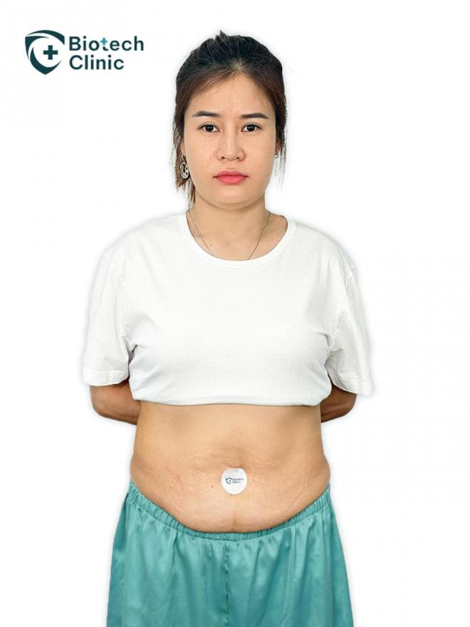 Giảm béo BioMaxthin, công nghệ đánh bay mỡ, Viện thẩm mỹ Công nghệ sinh học Biotech Clinic