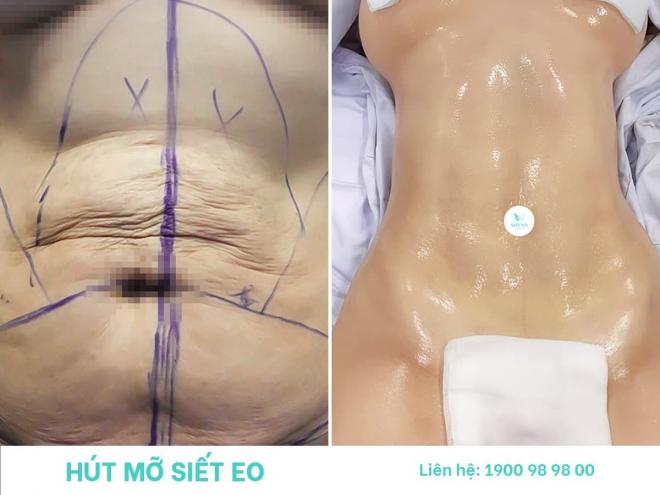 Hút Mỡ Siết Eo, Công nghệ Body Jet, Phòng Khám Phẫu Thuật Thẩm Mỹ Shynh Premium