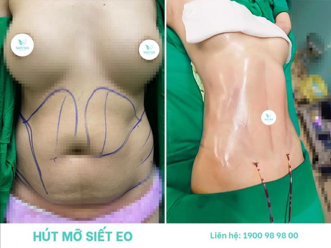 Hút Mỡ Siết Eo, Công nghệ Body Jet, Phòng Khám Phẫu Thuật Thẩm Mỹ Shynh Premium