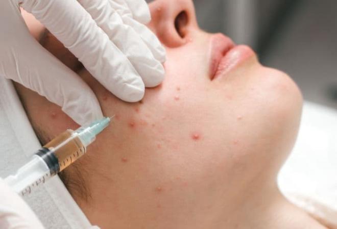 Tiêm meso trị mụn, meso trị mụn
