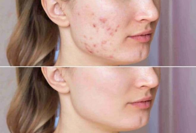 Tiêm meso trị mụn, meso trị mụn